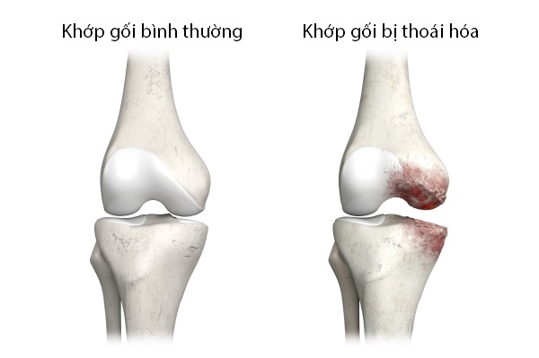 thoái hóa khớp