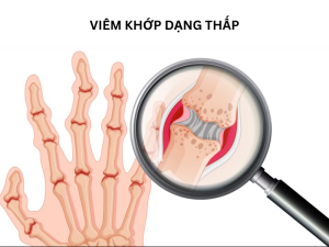 bệnh xương khớp viêm khớp dạng thấp